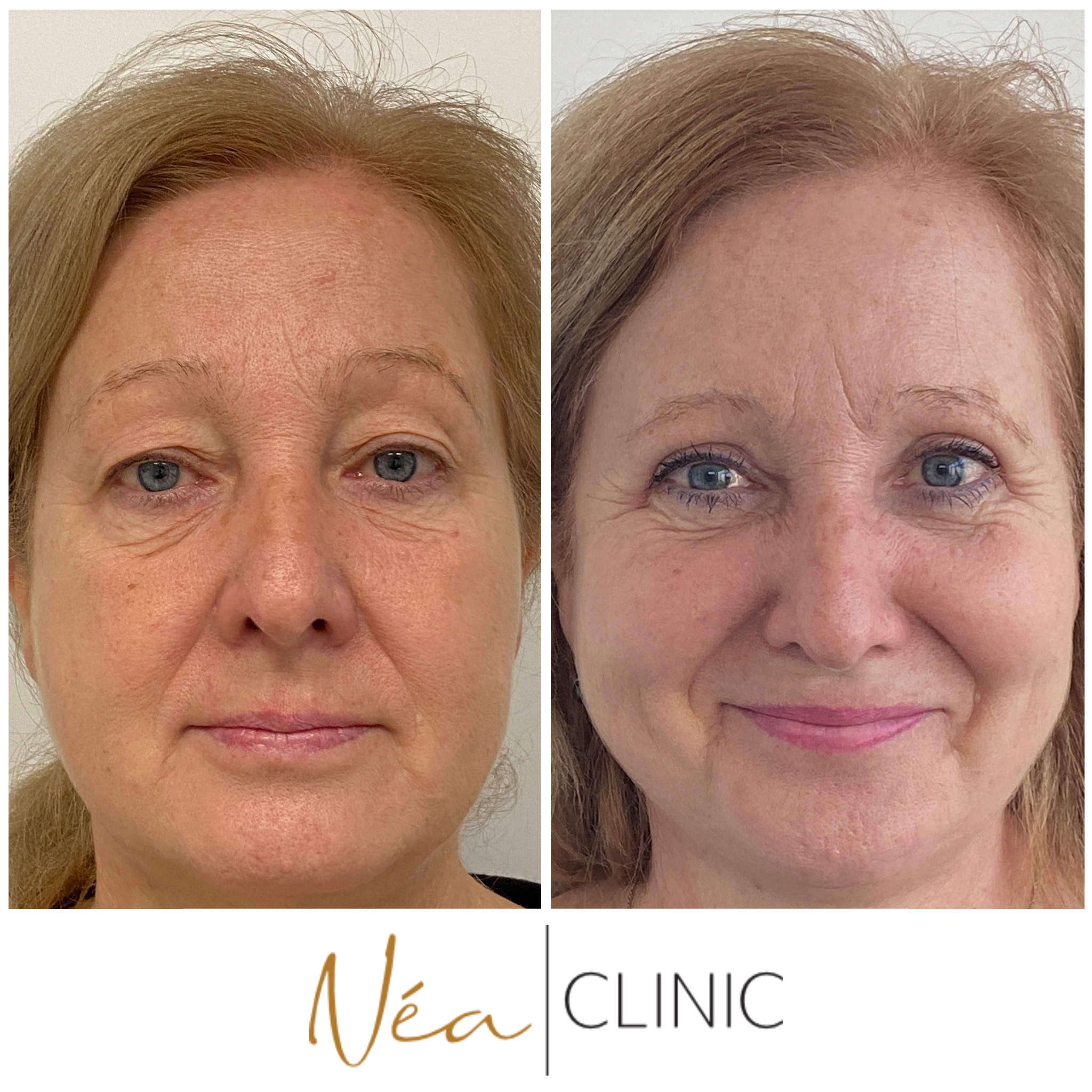 Jana - Blefaroplastika