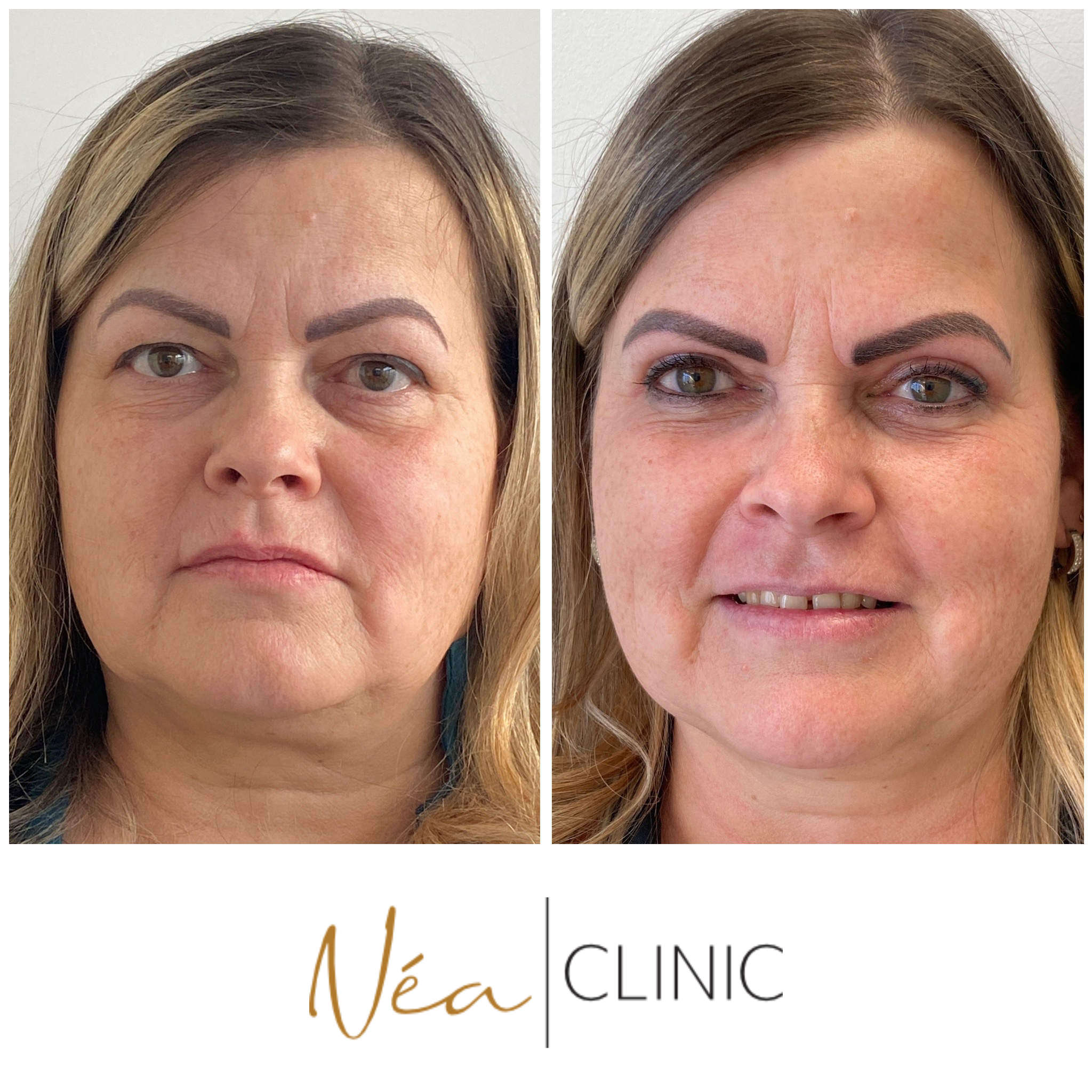 Kristína - Blefaroplastika