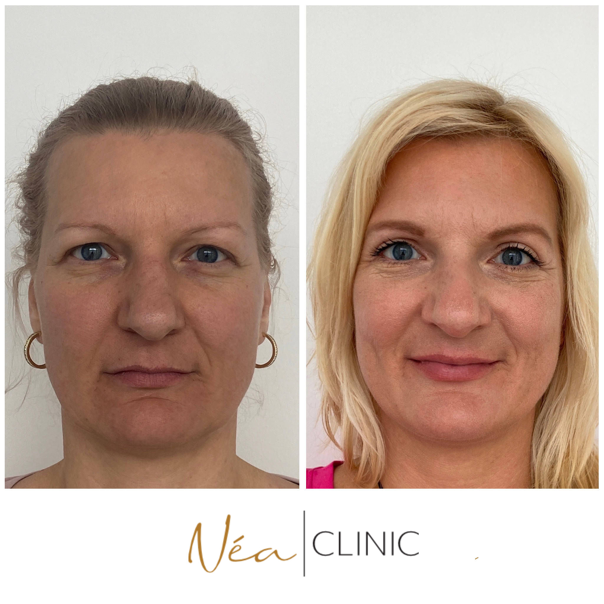 Vlaďka - Blefaroplastika