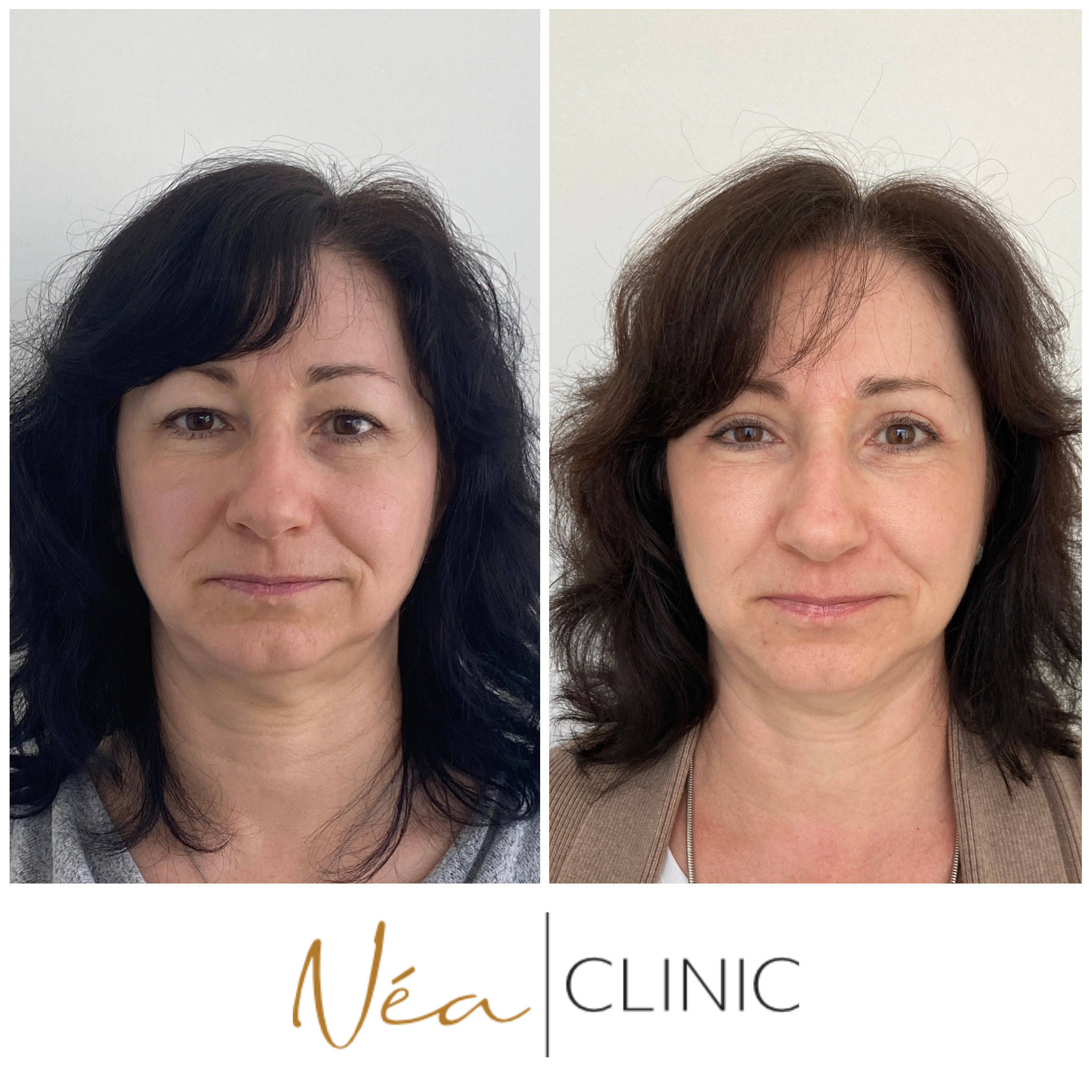 Václava - Blefaroplastika