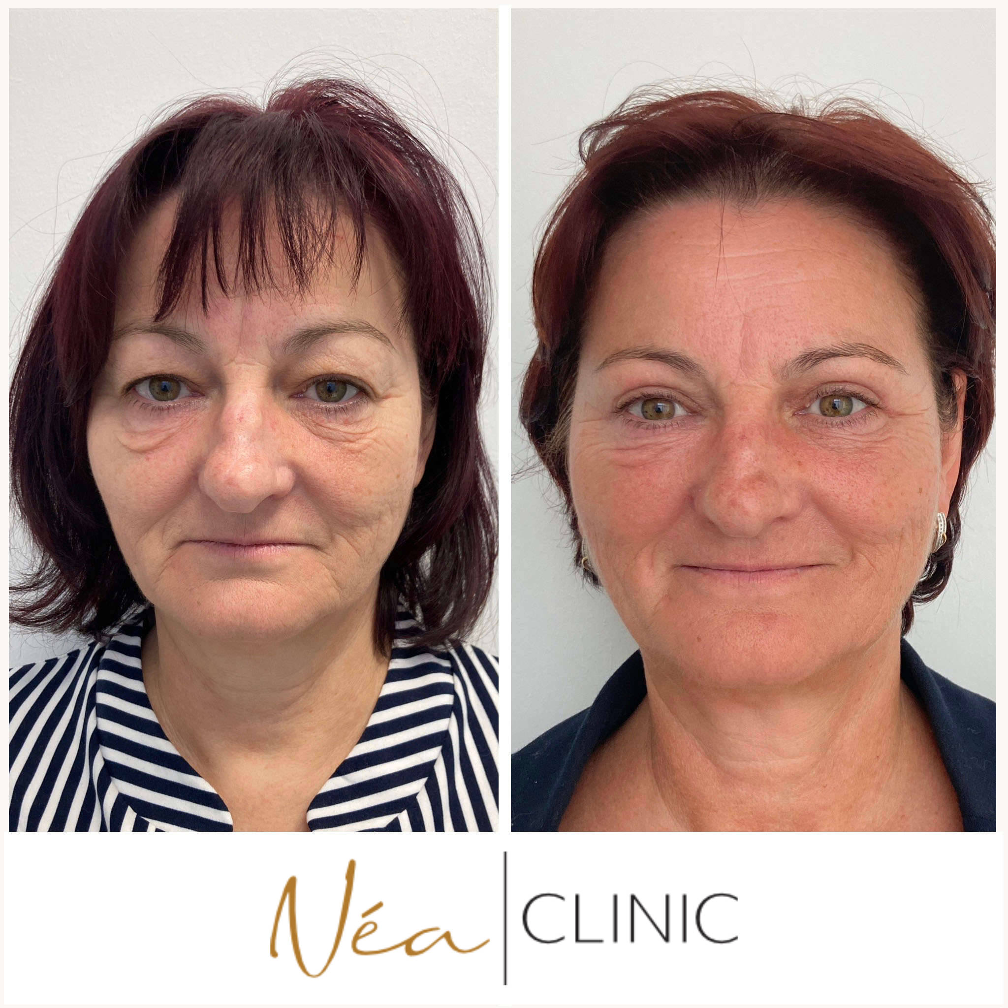 Ivana - Blefaroplastika