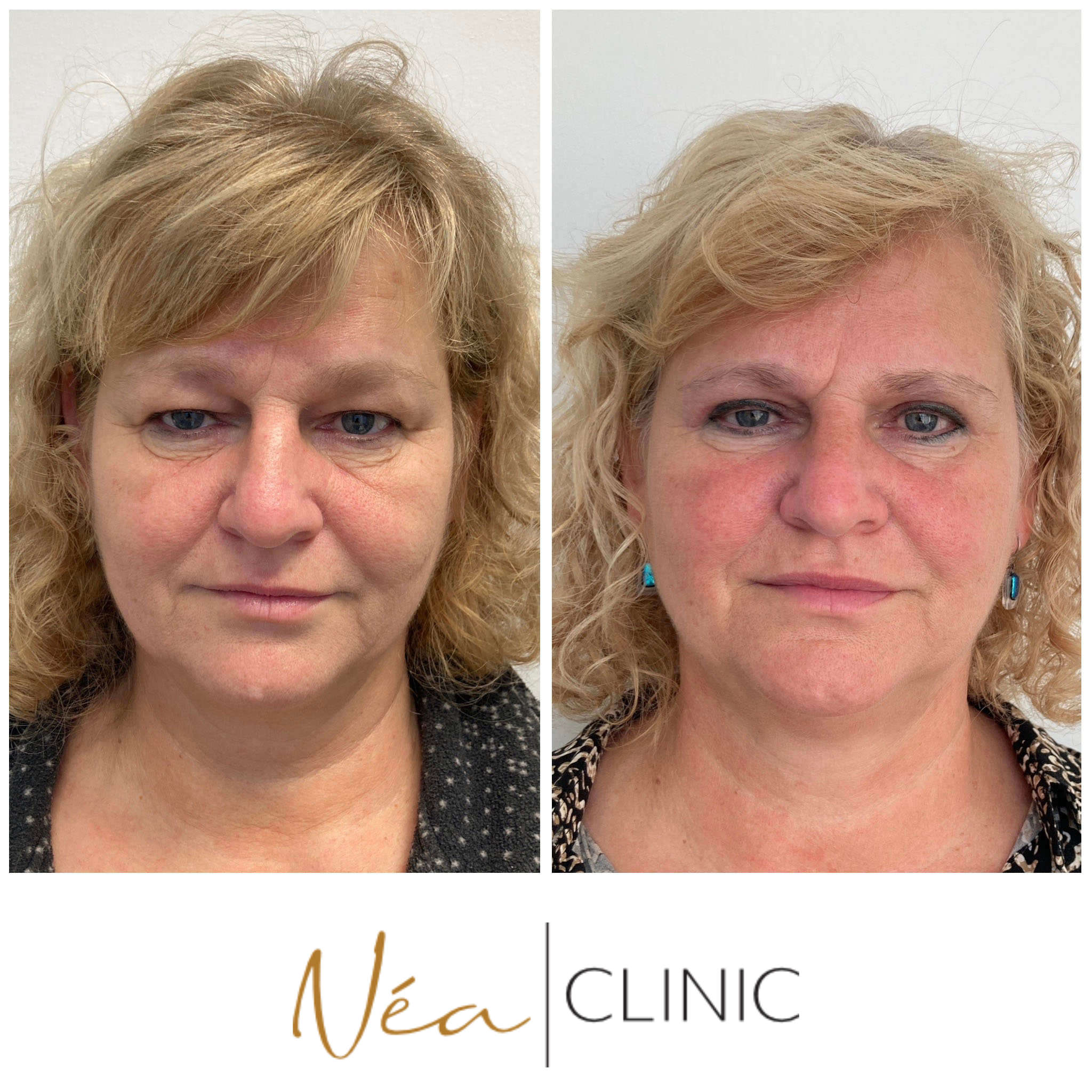 Jana - Blefaroplastika